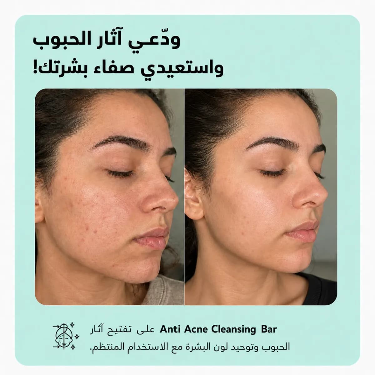 بار التنظيف — Anti-Acne™