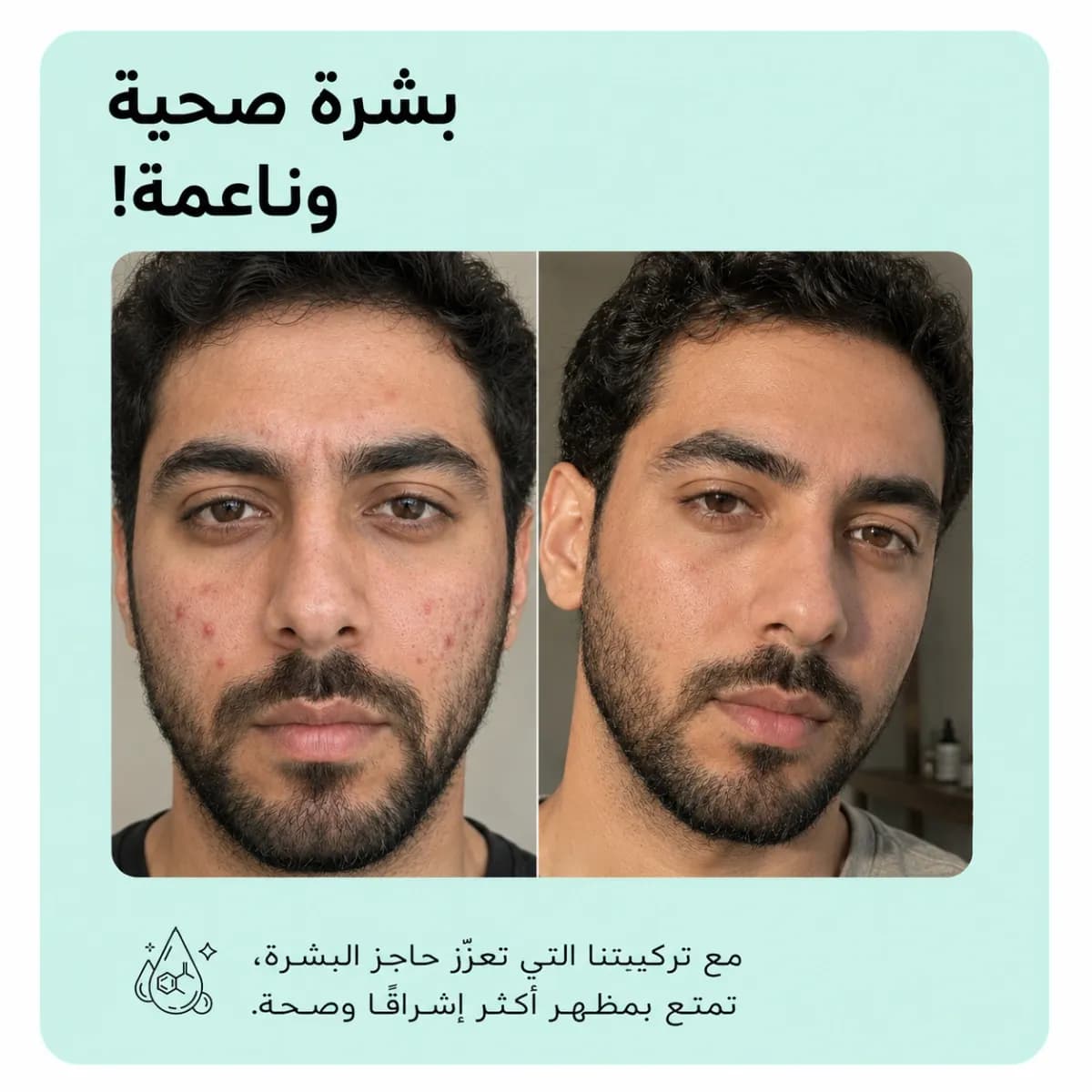 بار التنظيف — Anti-Acne™