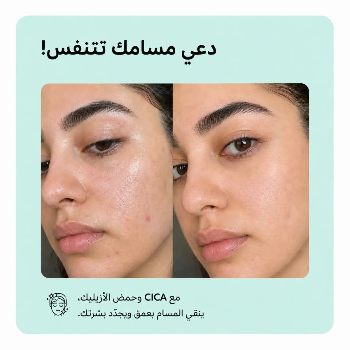 بار التنظيف — Anti-Acne™