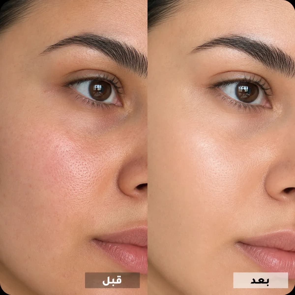 وداعاً للمسام، أهلاً بالبشرة الملساء