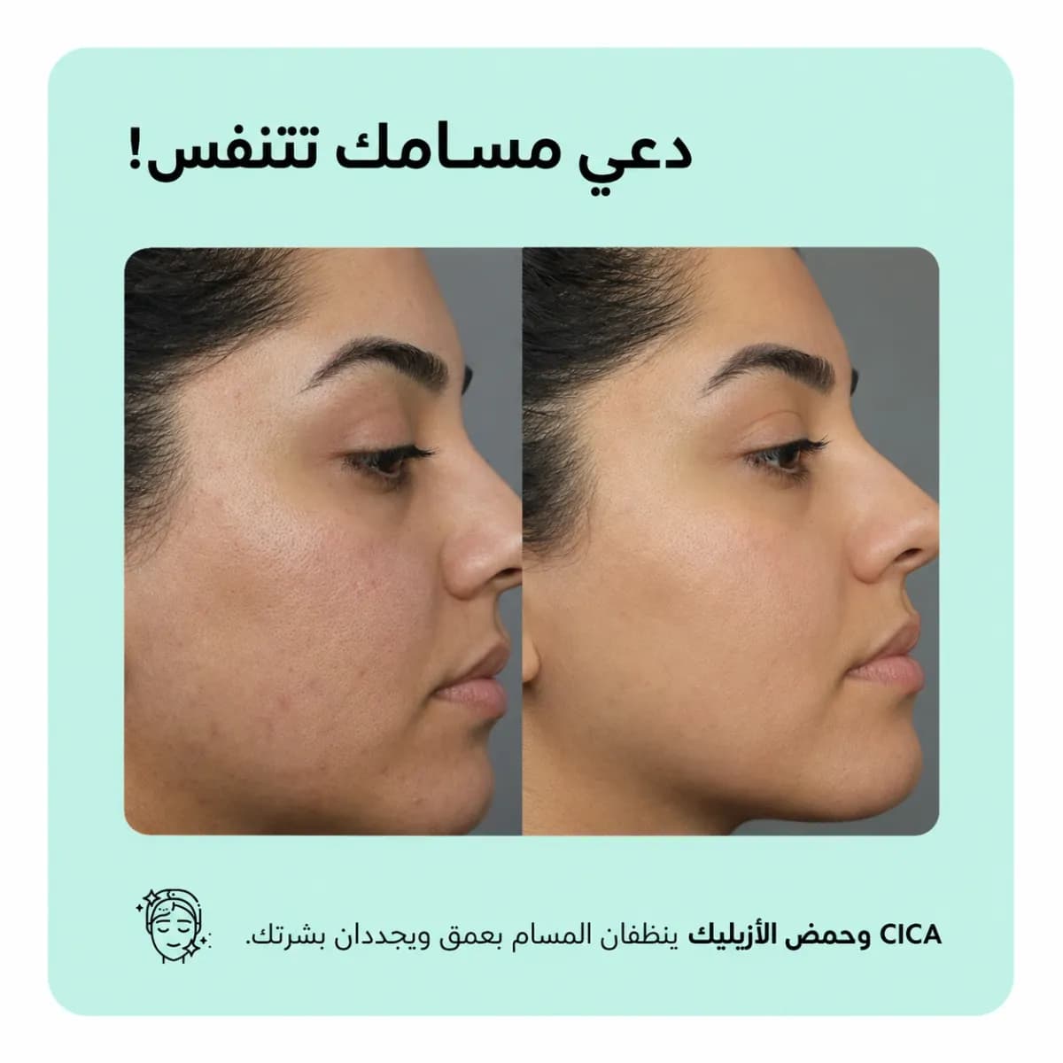 سيروم مكافحة حبّ الشباب — Anti-Acne™