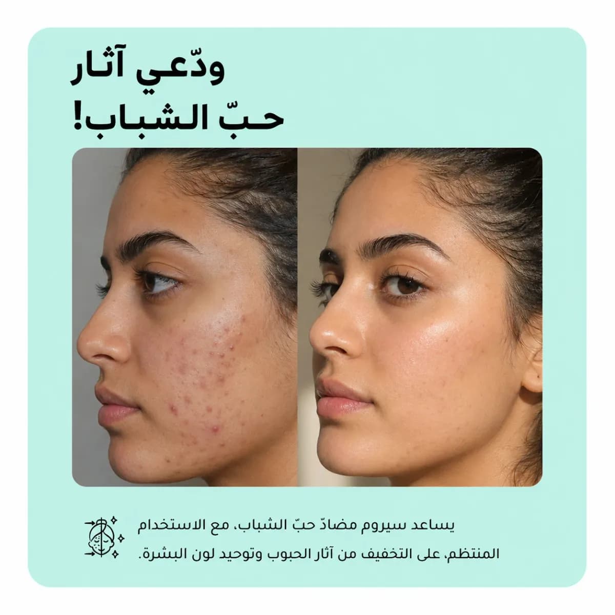 سيروم مكافحة حبّ الشباب — Anti-Acne™