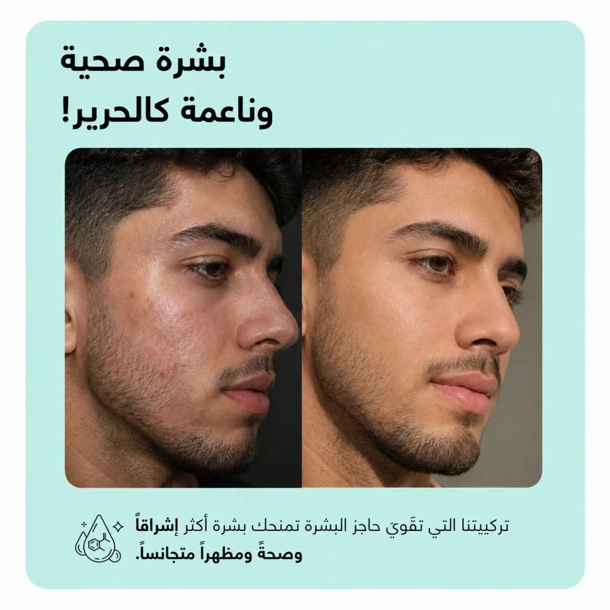 سيروم مكافحة حبّ الشباب — Anti-Acne™